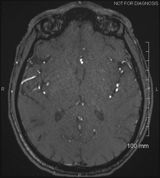 File:Anterior cerebral artery aneurysm (Radiopaedia 80683-94127 Axial MRA 131).jpg