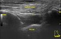 Anterior inferior tibiofibular ligament injury (Radiopaedia 79374).jpg
