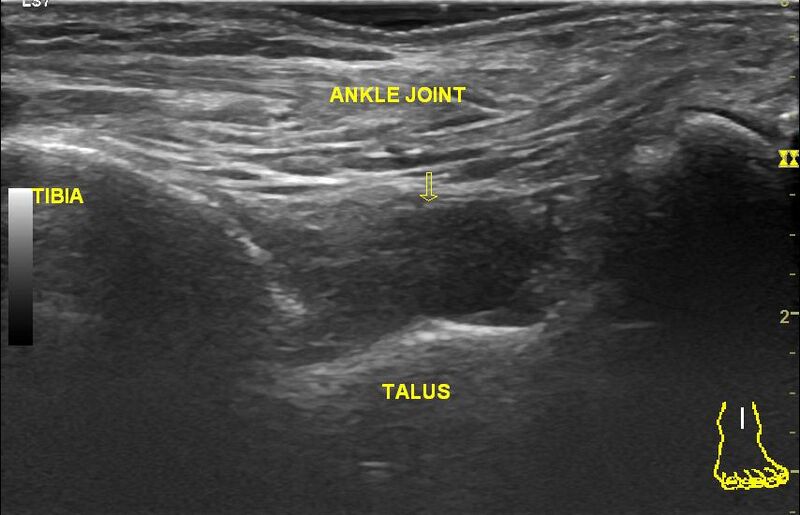 File:Anterior inferior tibiofibular ligament injury (Radiopaedia 79374).jpg