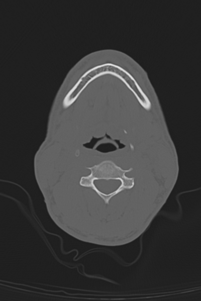 File:Anterior nasal spine fracture (Radiopaedia 46138-50494 Axial bone window 75).png