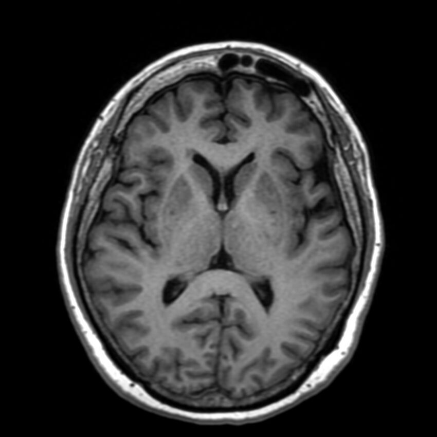 Anti-MOG encephalomyelitis (Radiopaedia 73831-84646 Axial T1 27).jpg
