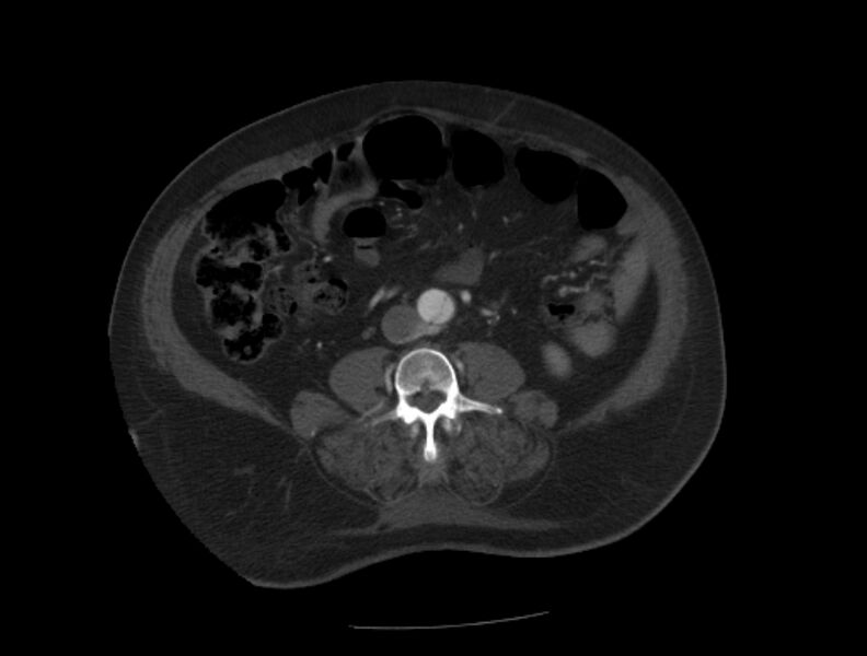 File:Aortic dissection (Radiopaedia 28802-29105 A 70).jpg