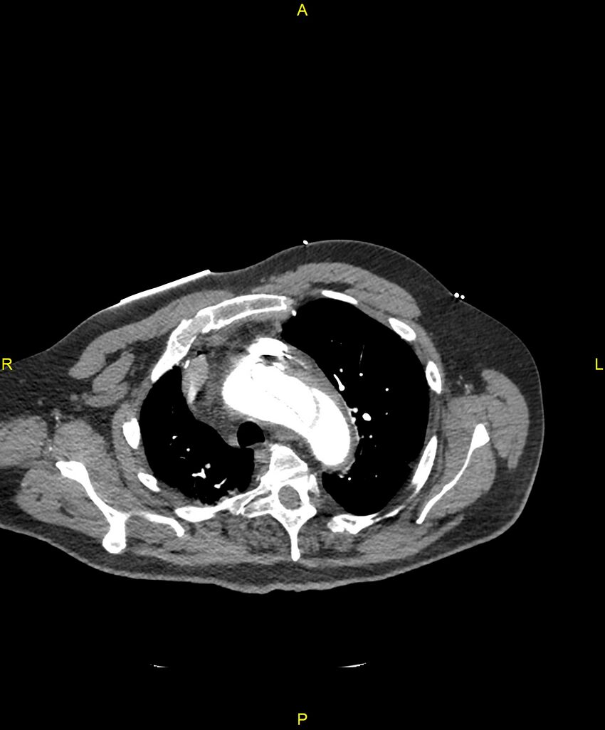 Aortic rupture (Radiopaedia 88822-105594 B 60).jpg