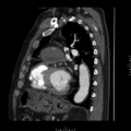 Aorto-coronary bypass graft aneurysms (Radiopaedia 40562-43157 C 27).png