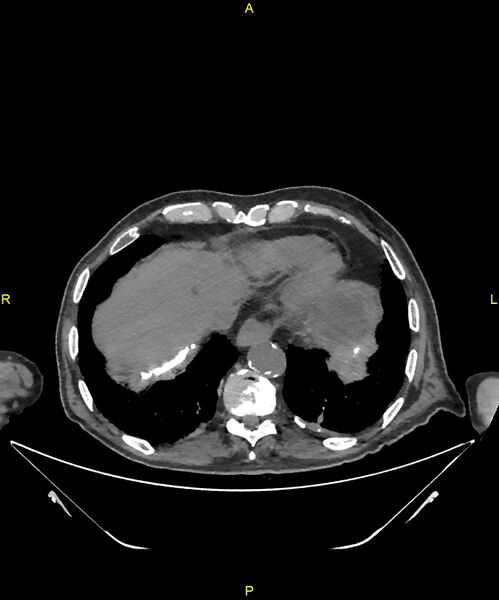 File:Aortoenteric fistula (Radiopaedia 84308-99603 Axial non-contrast 17).jpg