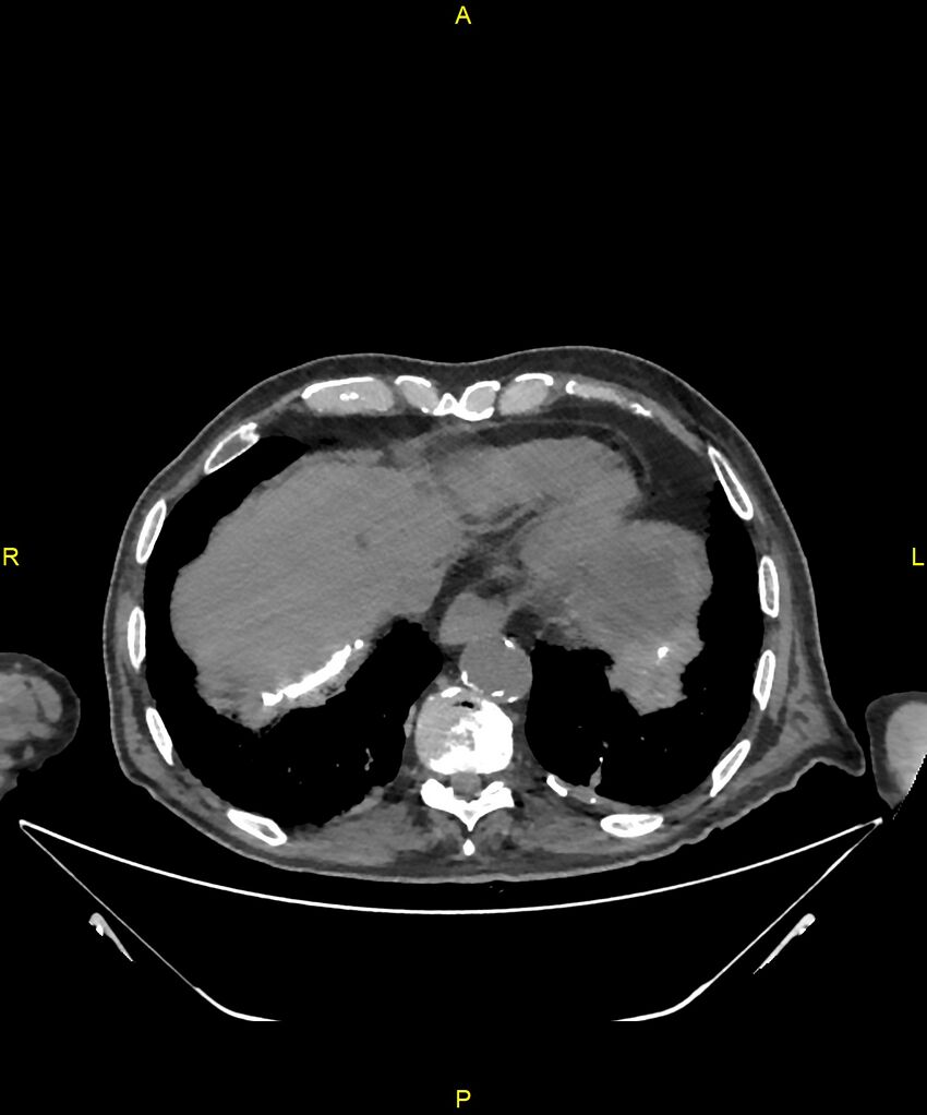 Aortoenteric fistula (Radiopaedia 84308-99603 Axial non-contrast 17).jpg