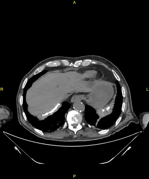 File:Aortoenteric fistula (Radiopaedia 84308-99603 Axial non-contrast 22).jpg