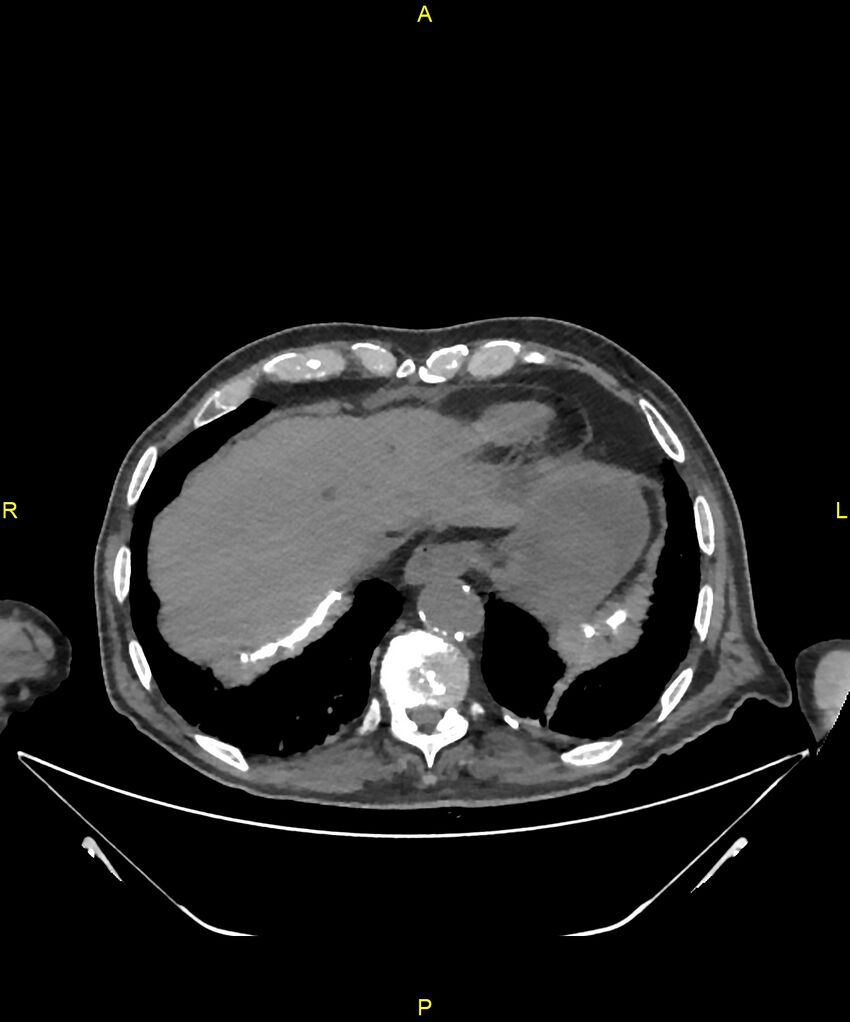 Aortoenteric fistula (Radiopaedia 84308-99603 Axial non-contrast 22).jpg