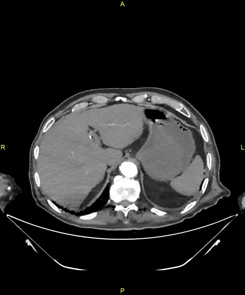 Aortoenteric fistula (Radiopaedia 84308-99603 B 48).jpg