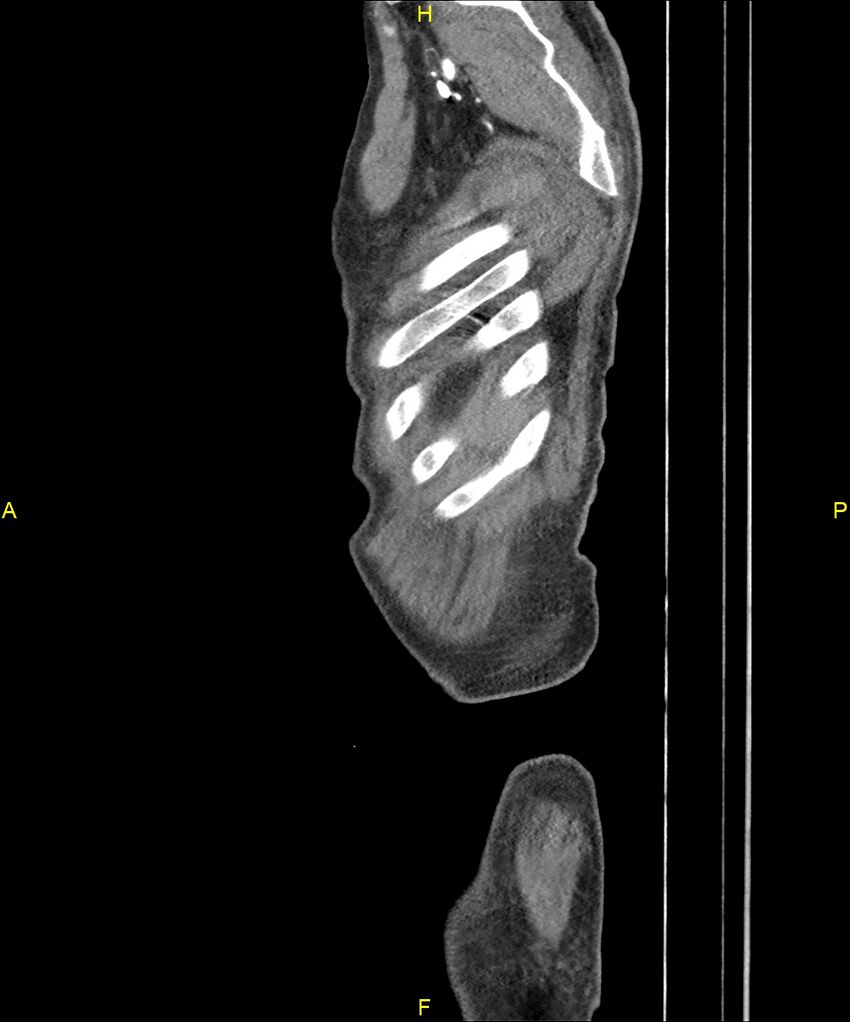 Aortoenteric fistula (Radiopaedia 84308-99603 C 325).jpg