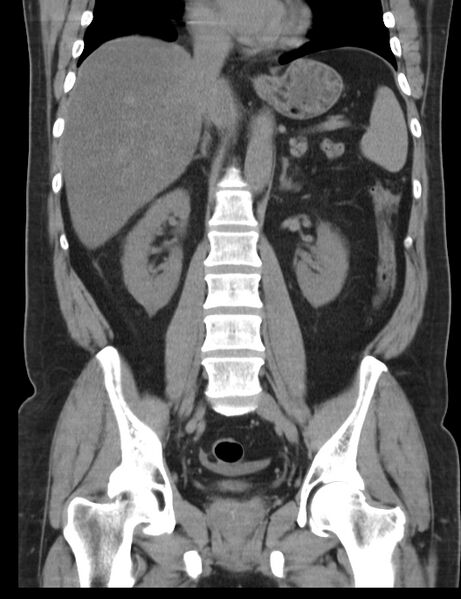 File:Appendicitis and giant appendicolith (Radiopaedia 80251-93588 Coronal non-contrast 28).jpg