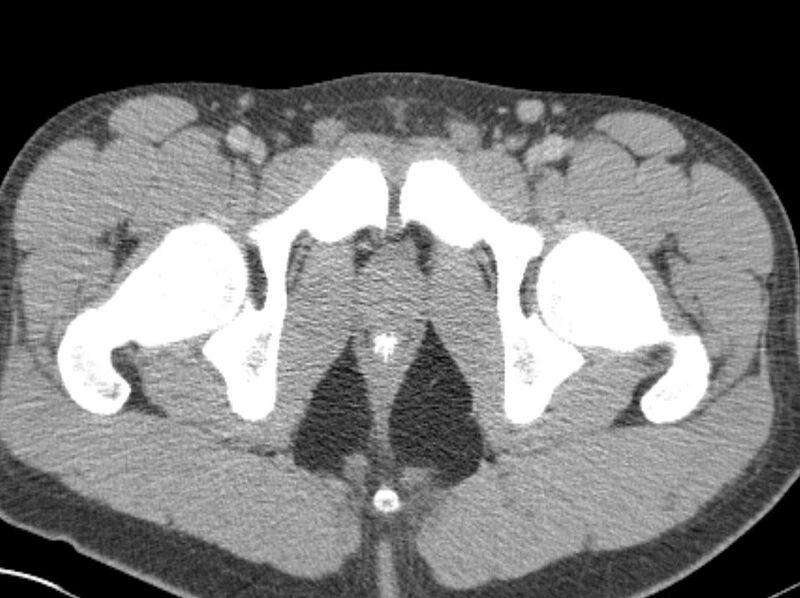 File:Appendicitis and incidental foregut duplication cyst (Radiopaedia 52962-58916 A 105).jpg