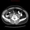 Appendicitis and renal cell carcinoma (Radiopaedia 17063-16760 A 38).jpg