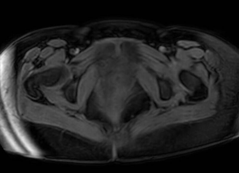 File:Appendicitis in gravida (MRI) (Radiopaedia 89433-106395 Axial DIXON 148).jpg
