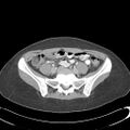Appendicitis with minimal stranding but appendicolith (Radiopaedia 29035-29397 A 60).jpg