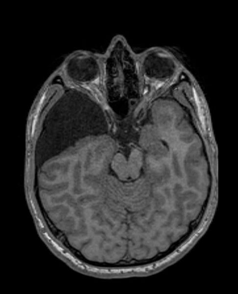 File:Arachnoid cyst- extremely large (Radiopaedia 68741-78451 Axial T1 29).jpg
