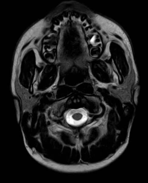 File:Arachnoid cyst- extremely large (Radiopaedia 68741-78451 Axial T2 1).jpg