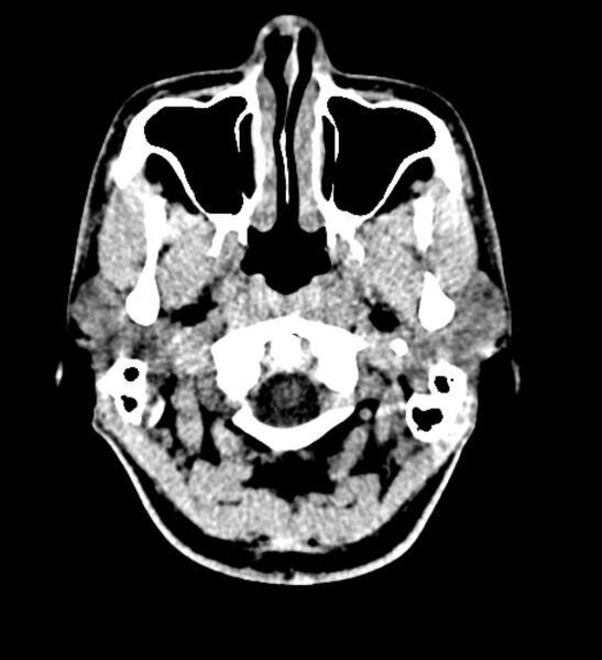 File:Arachnoid cyst of the ambient cistern (Radiopaedia 81301-94986 Axial non-contrast 1).jpg