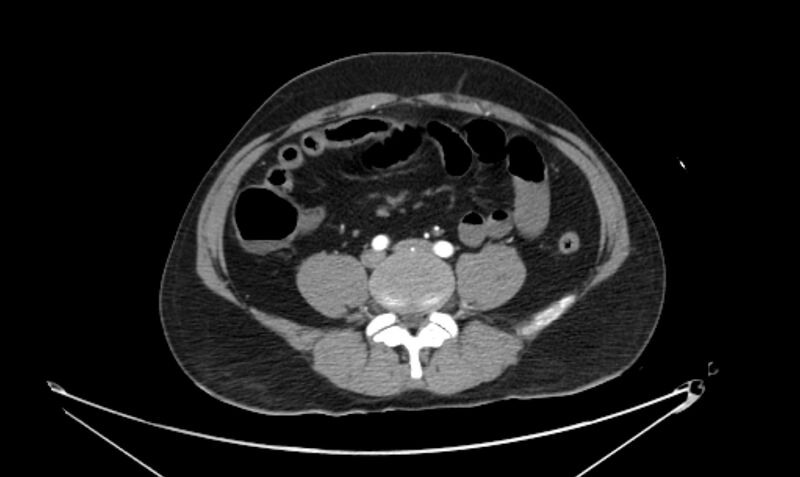 File:Arterial occlusive mesenteric ischemia (Radiopaedia 84641-100060 A 87).jpg