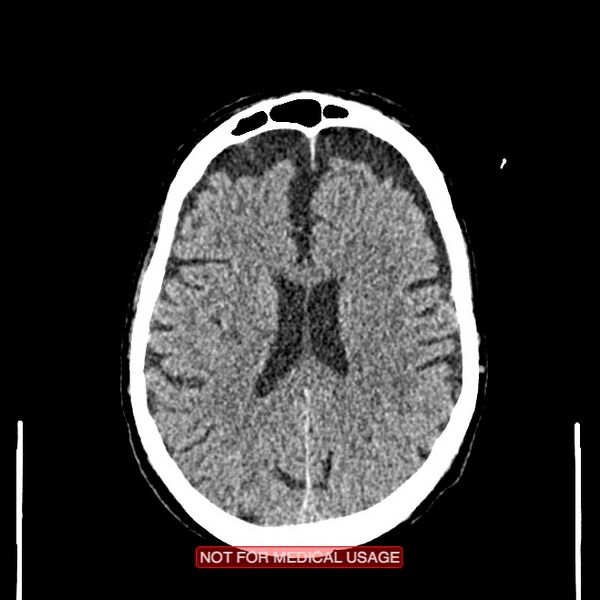 File:Artery of Percheron infarction (Radiopaedia 28679-28967 Axial non-contrast 75).jpg