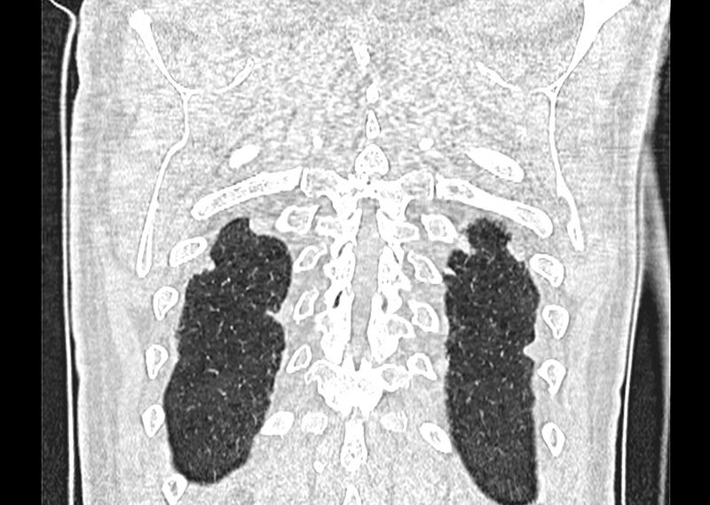 File:Asbestos pleural placques (Radiopaedia 57905-64872 Coronal lung window 266).jpg