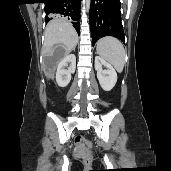 File:Ascending retrocecal appendicitis with liver abscesses (Radiopaedia 60066-67615 C 8).jpg
