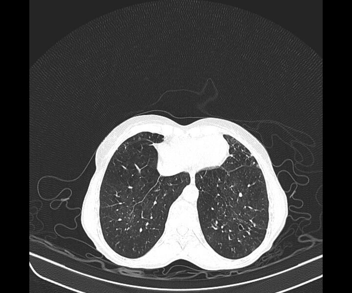 File:Aspergillomas (Radiopaedia 66779-76110 Axial lung window 37).jpg
