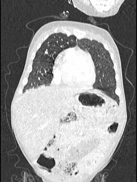 File:Asplenia syndrome (Radiopaedia 73083-83792 Coronal lung window 29).jpg