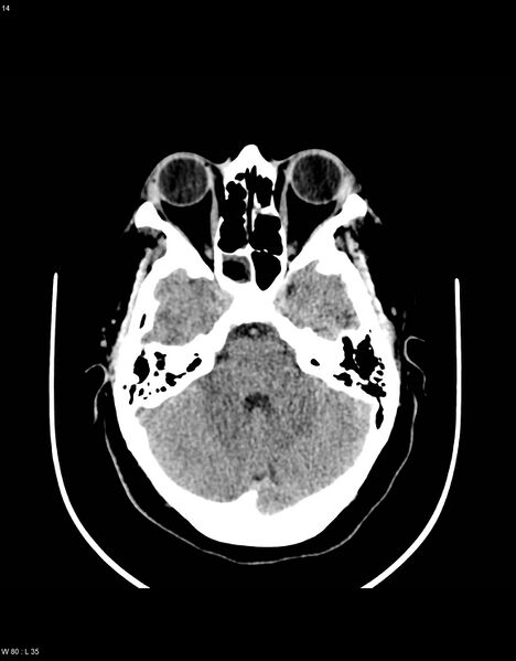 File:Astroblastoma (Radiopaedia 39792-42216 Axial non-contrast 13).jpg