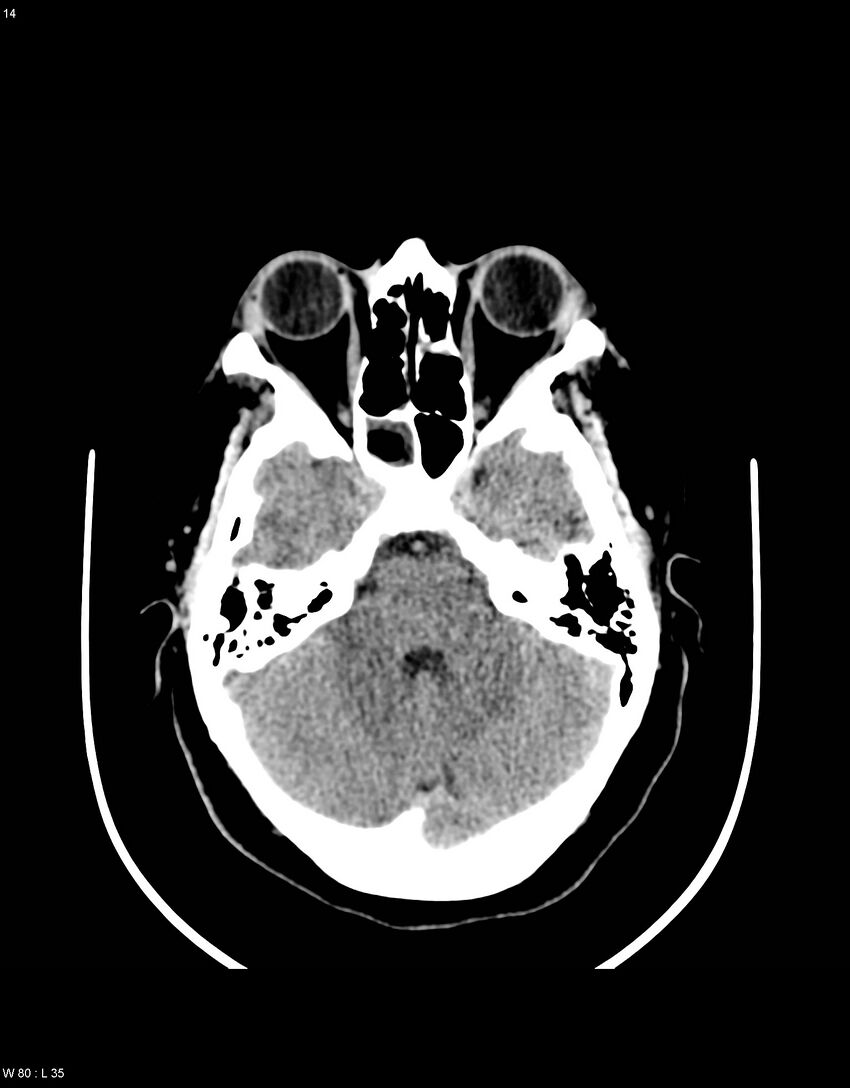 Astroblastoma (Radiopaedia 39792-42216 Axial non-contrast 13).jpg