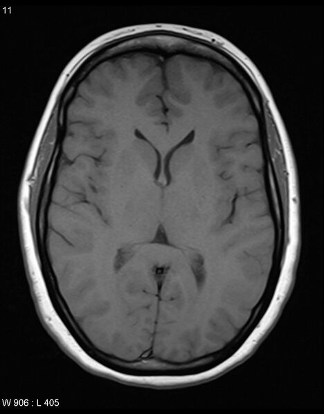File:Astroblastoma (Radiopaedia 39792-42217 Axial T1 10).jpg