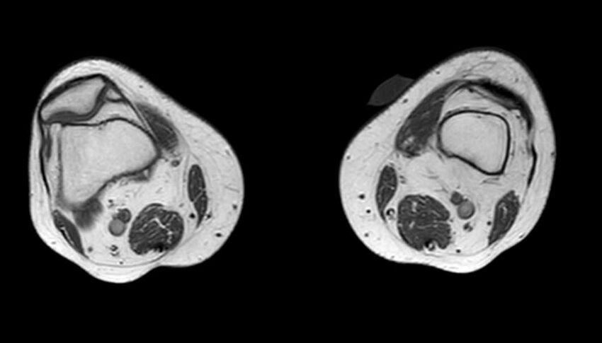 Atypical lipomatous tumor - thigh (Radiopaedia 68975-78734 Axial T1 16).jpg