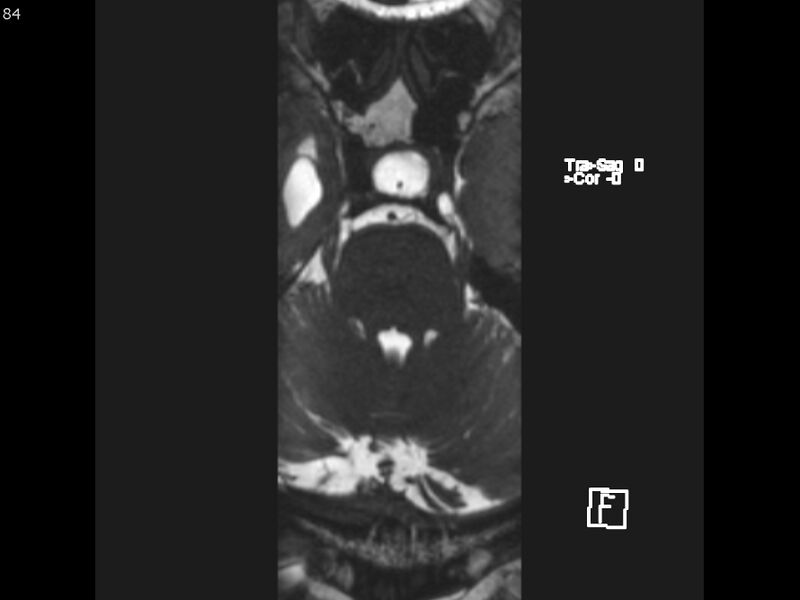 File:Atypical meningioma - intraosseous (Radiopaedia 64915-74572 Axial CISS 84).jpg