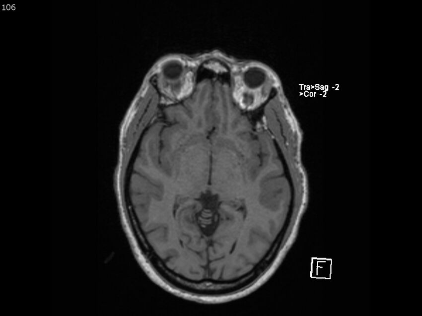 Atypical meningioma - intraosseous (Radiopaedia 64915-74572 Axial T1 106).jpg