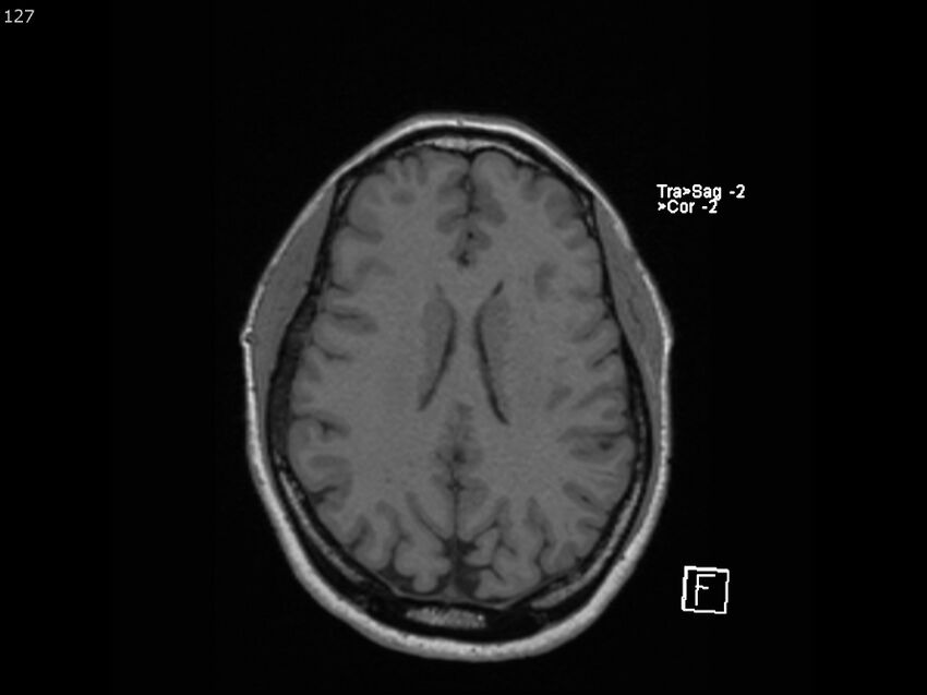 Atypical meningioma - intraosseous (Radiopaedia 64915-74572 Axial T1 127).jpg