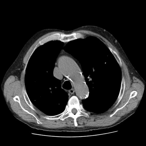 File:Autosomal dominant polycystic kidney disease (Radiopaedia 27851-28094 Axial non-contrast 18).jpg