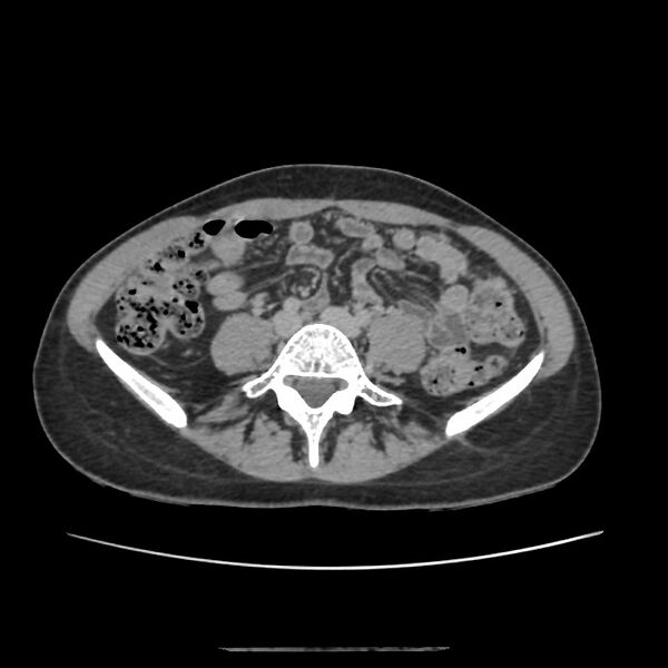 File:Autosomal dominant polycystic kidney disease - early onset (Radiopaedia 40734-43387 D 16).jpg