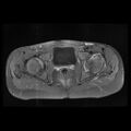 Avascular necrosis of the hip (Radiopaedia 29563-30067 Axial T1 C+ fat sat 8).jpg