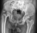 Avascular necrosis of the hip joint (Radiopaedia 61766).PNG