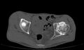 Avascular necrosis of the left hip (Radiopaedia 75068-86125 Axial bone window 31).jpg