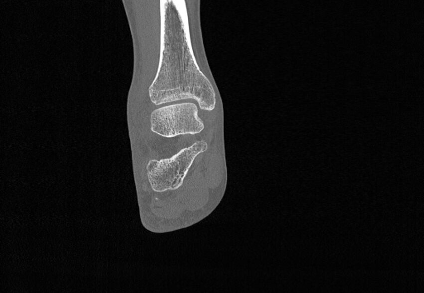 Avulsion fractures of talus and calcaneus (Radiopaedia 48277-53155 Coronal bone window 59).jpg