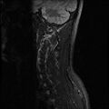 Axis fracture - MRI (Radiopaedia 71925-82375 Sagittal STIR 1).jpg