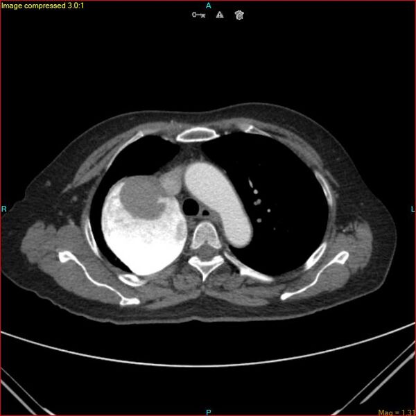 File:Azygos vein aneurysm (Radiopaedia 77824-90130 B 20).jpg