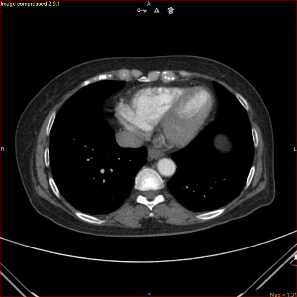 File:Azygos vein aneurysm (Radiopaedia 77824-90130 B 41).jpg