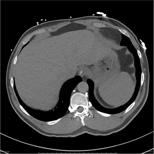 File:Azygos venous system anatomy (CT pulmonary angiography) (Radiopaedia 25928-26077 Axial C+ CTPA 78).jpg