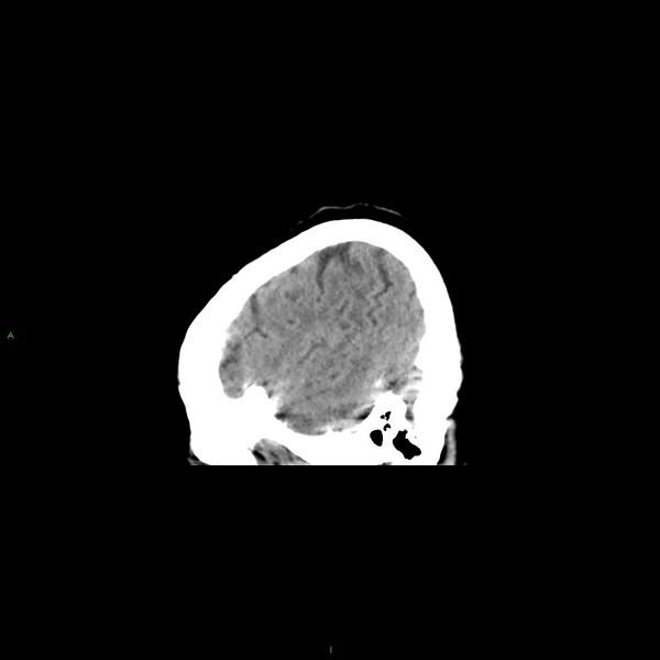 File:Basal ganglia hemorrhage (Radiopaedia 58349-65472 C 8).jpg
