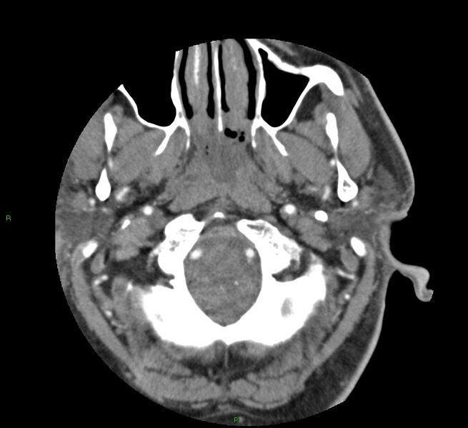 File:Basal ganglia hemorrhage (Radiopaedia 58763-65985 D 16).jpg