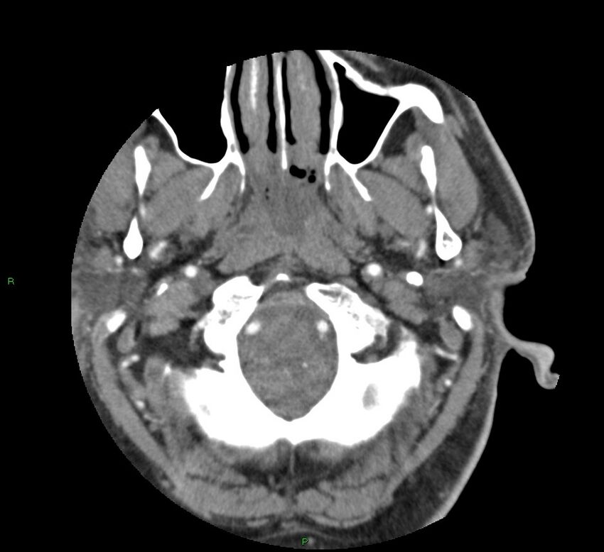 Basal ganglia hemorrhage (Radiopaedia 58763-65985 D 16).jpg