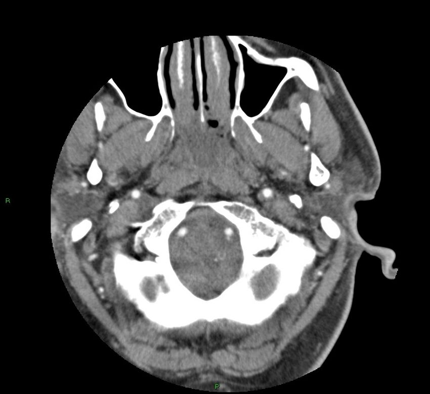 Basal ganglia hemorrhage (Radiopaedia 58763-65985 D 18).jpg