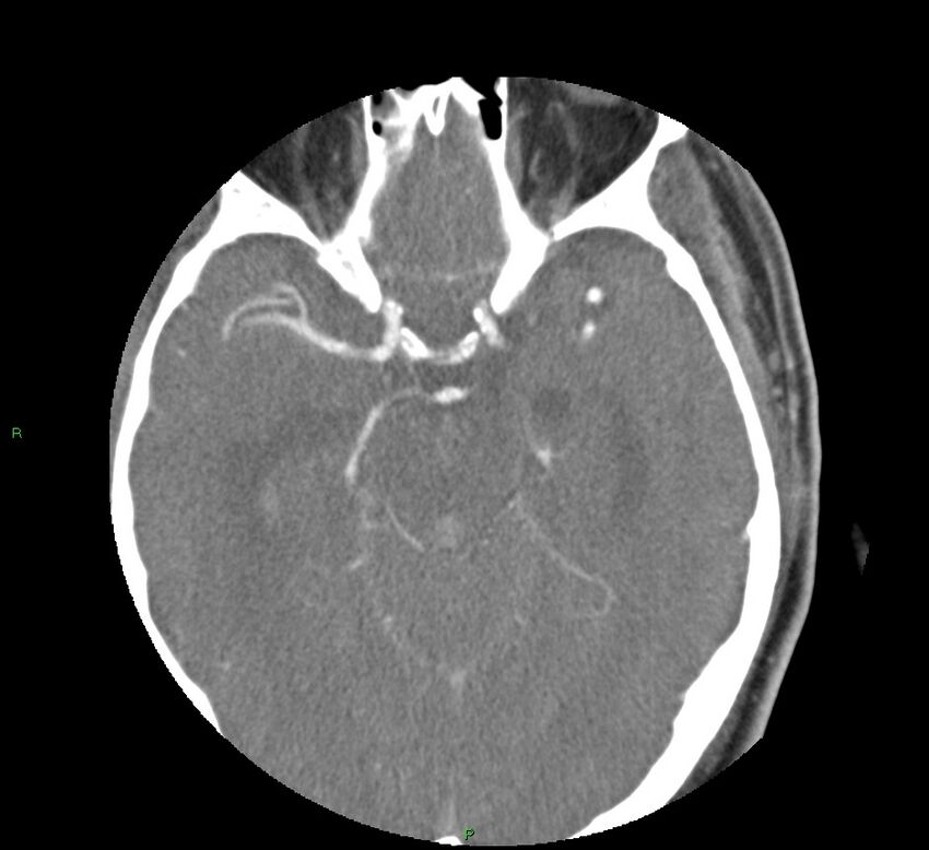 Basal ganglia hemorrhage (Radiopaedia 58763-65985 D 75).jpg